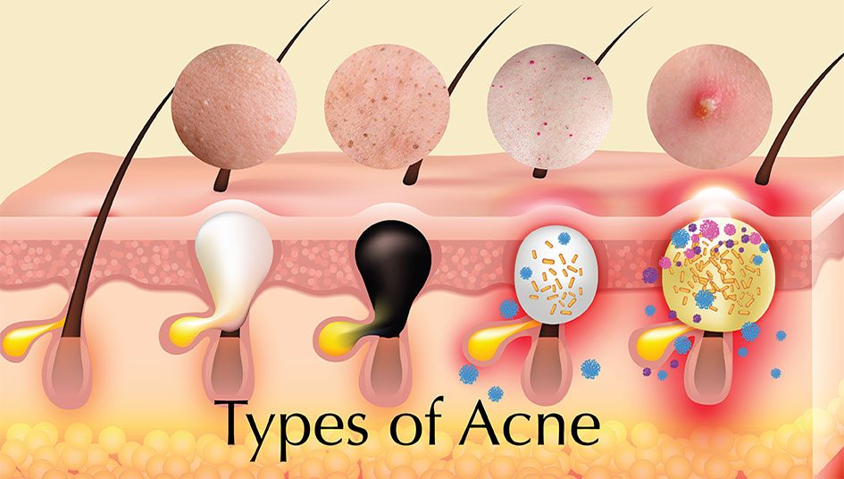 Acne-Skin-945×536 Acne-Skin-945x536