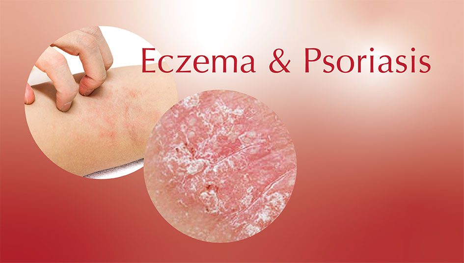 Eczema-&-Psoriasis-945×536 Eczema-&-Psoriasis-945x536