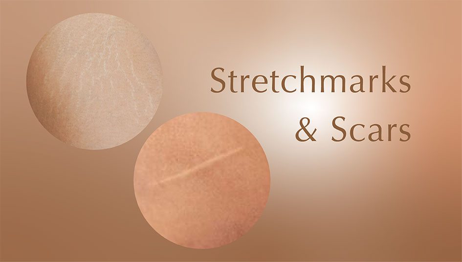 Sacrs-&-Stretchmarks-945×356 Sacrs-&-Stretchmarks-945x356